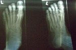 Röntgenaufnahme eines linken Gichtfußes